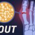 Gout symptoms