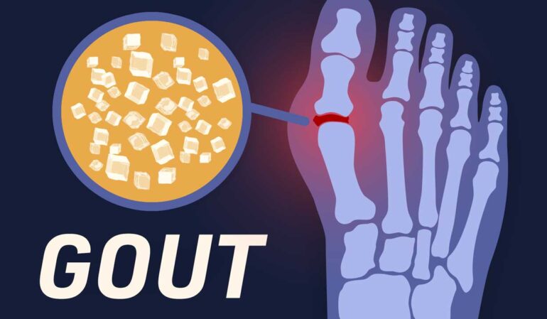 Gout symptoms